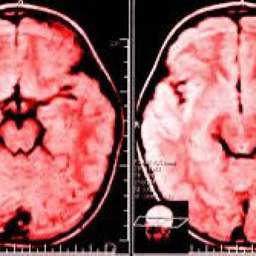 foto-cerebro