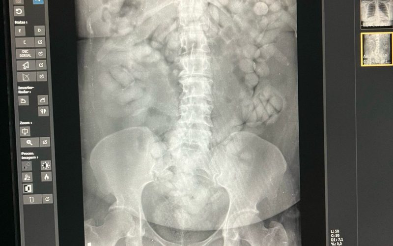 “Mula” tenta embarcar para Paris com 100 cápsulas de cocaína no estômago